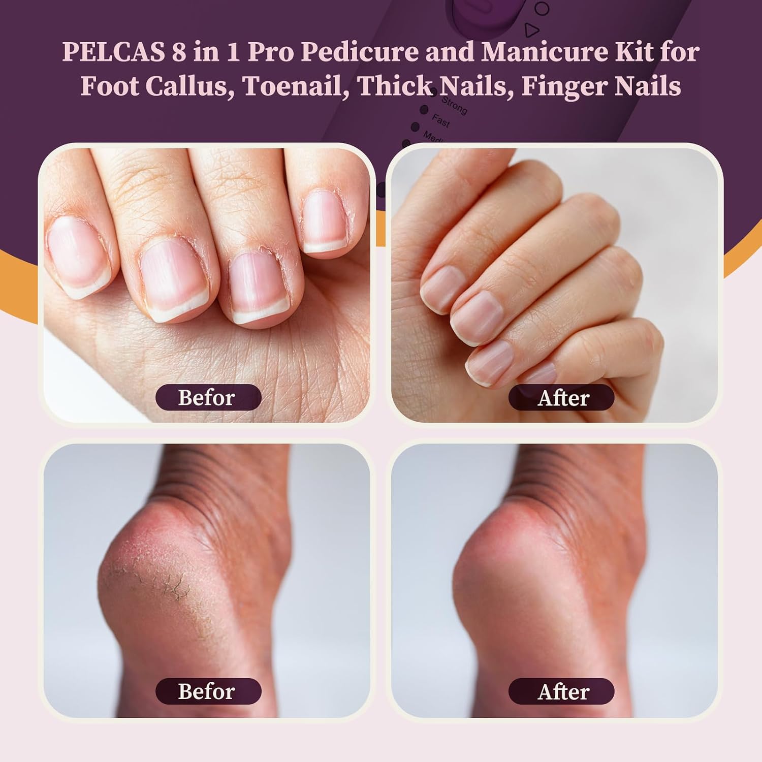 Pelcas Toenail Grinder For Thick Toenails 8 In 1 Manicure & Pedicure Kit